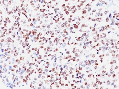Staining by anti-Microphthalmia Transcription Factor Antibody 1