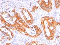 Staining by anti-MUC1 / EMA / CD227 Antibody 1