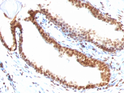 Formalin-fixed, paraffin-embedded human Colon Carcinoma stained with Double Stranded DNA Monoclonal Antibody (DSD/958)