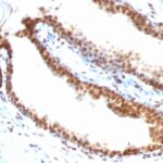 Formalin-fixed, paraffin-embedded human Colon Carcinoma stained with Double Stranded DNA Monoclonal Antibody (DSD/958)