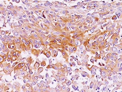 Formalin-fixed, paraffin-embedded human Melanoma stained with gp1 / Melanosome Monoclonal Antibody (NKI-beteb),