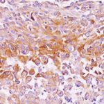 Formalin-fixed, paraffin-embedded human Melanoma stained with gp1 / Melanosome Monoclonal Antibody (NKI-beteb),