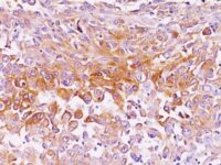 Formalin-fixed, paraffin-embedded human Melanoma stained with gp1 / Melanosome Monoclonal Antibody (NKI-beteb),